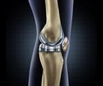 Knee replacement surgery outcomes improve with native alignment approach